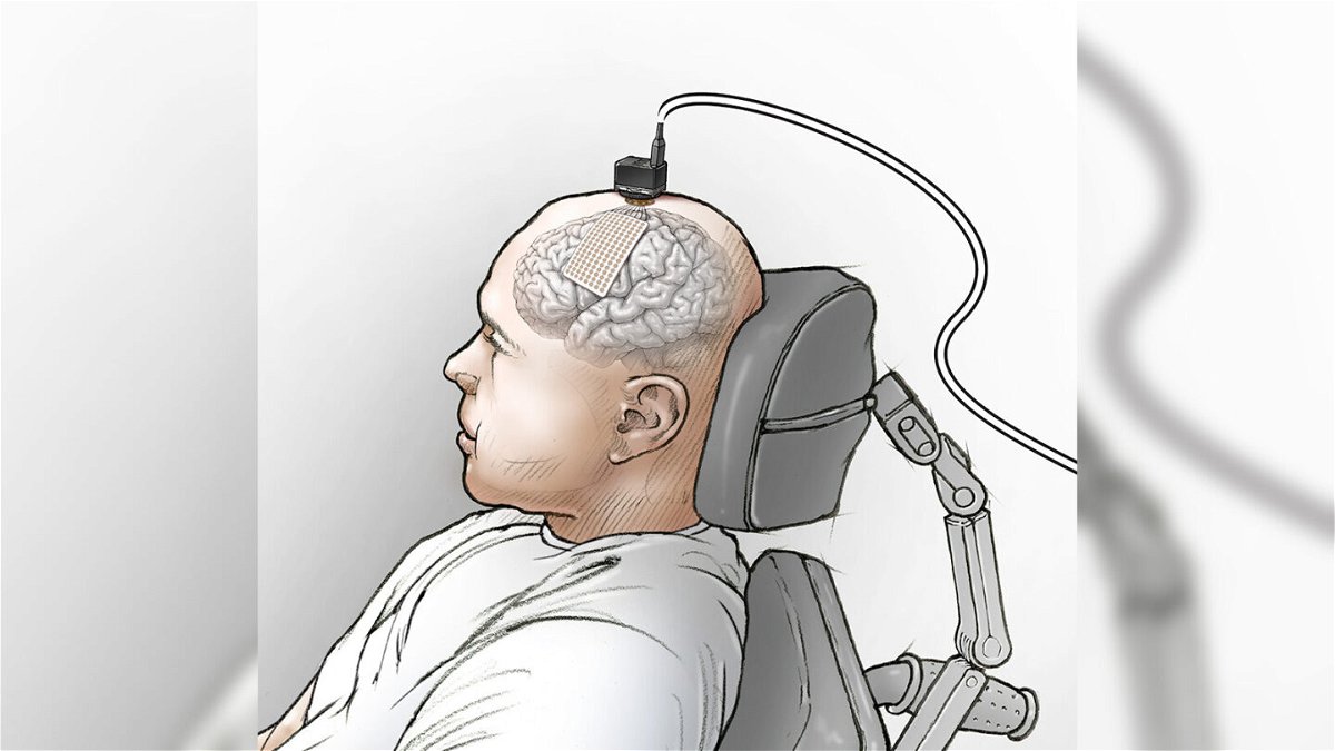 <i>Courtesy Ken Probst/UCSF</i><br/>An Illustration shows placement of the eCOG electrode on the participant's speech motor cortex and the head stages used to connect the electrode to the computer.