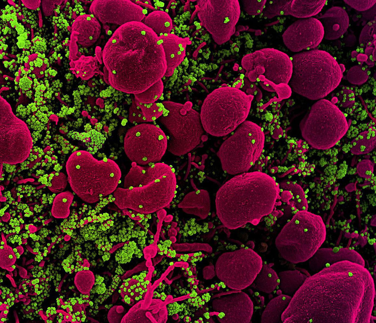 <i>NIAID</i><br/>Colorized scanning electron micrograph of an apoptotic cell (pink) heavily infected with SARS-COV-2 virus particles.