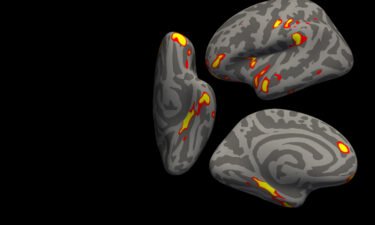 The red-yellow regions are the parts of the brain that shrink the most in the 401 SARS- CoV-2 infected participants