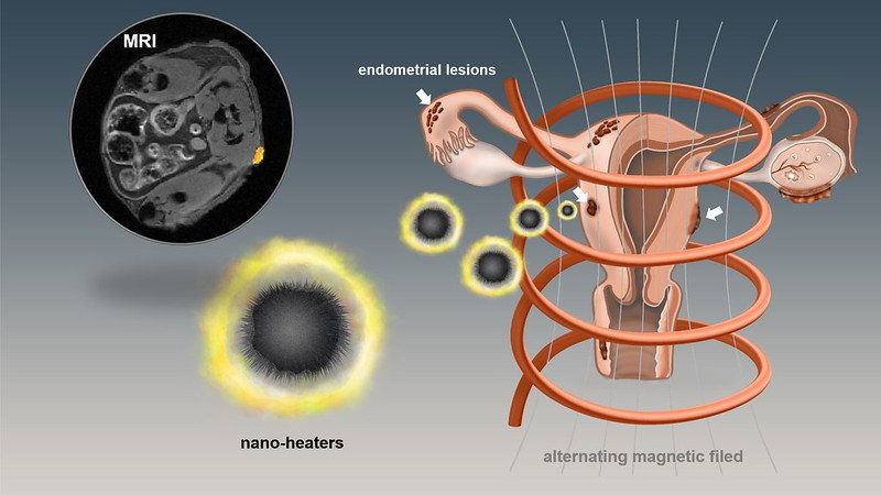 Scientists have developed a new nanotechnology approach for locating and removing the painful and dangerous lesions associated with endometriosis, a common gynecological condition in women of childbearing age