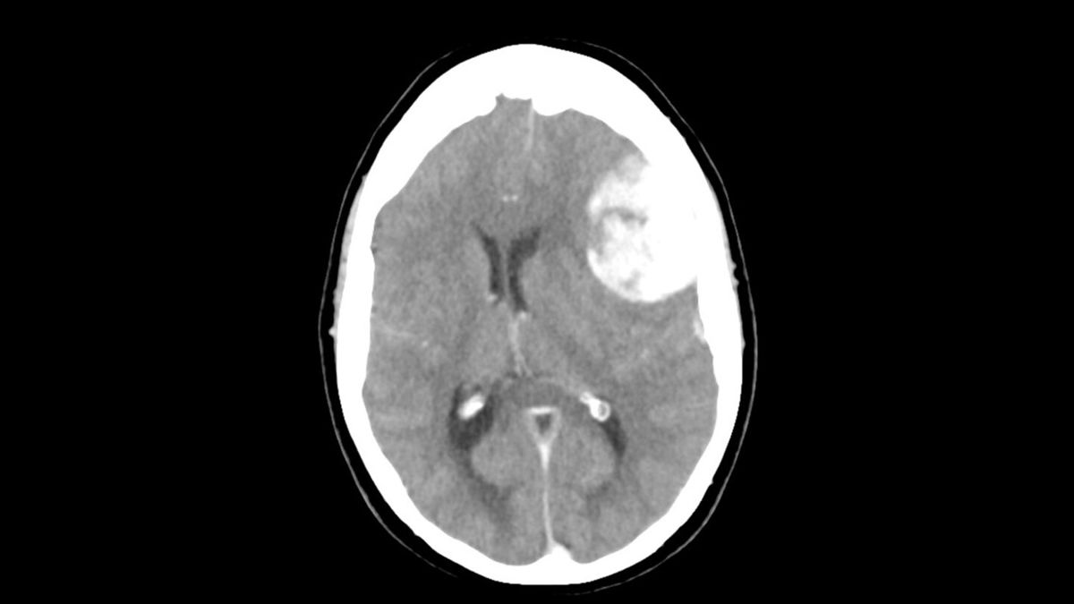 <i>Dr Henry Knipe/Radiopaedia.org</i><br/>A shortage of a key component for some crucial imaging tests such as CT scans is leading to rationing within hospitals