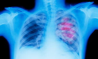 Seen here is an illustration of an X-ray depicting lung cancer. A new study shows that nearly half of deaths due to cancer can be attributable to preventable risk factors.