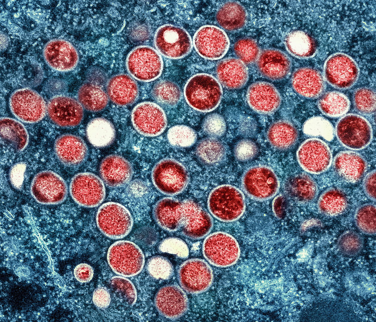 <i>NIAID/AP</i><br/>This image provided by the National Institute of Allergy and Infectious Diseases (NIAID) shows a colorized transmission electron micrograph of monkeypox particles (red) found within an infected cell (blue).