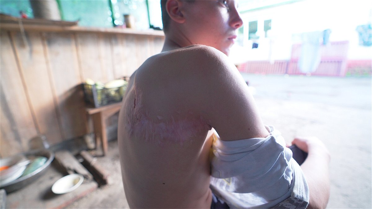 <i>CNN</i><br/>The deep scars on Serhii's back are a permanent reminder of his survival.