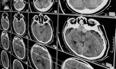 6 most common causes of traumatic brain injuries