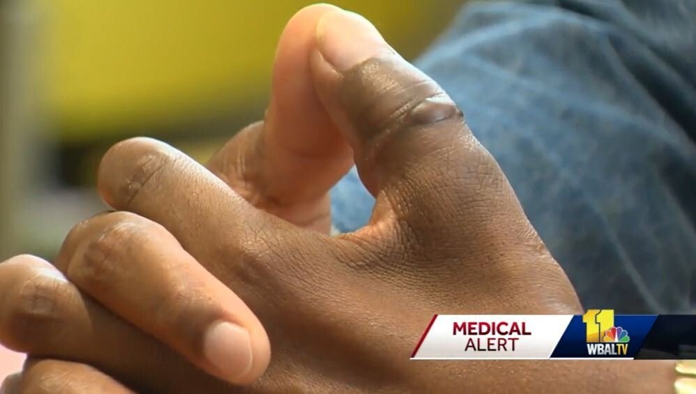 <i>WBAL</i><br/>A Maryland man who lost his thumb in a dog bite got it back and is recovering thanks to doctors in Baltimore.