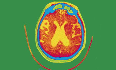 Seen here is a scan of the brain of a patient affected by Alzheimer's disease. An experimental therapy
