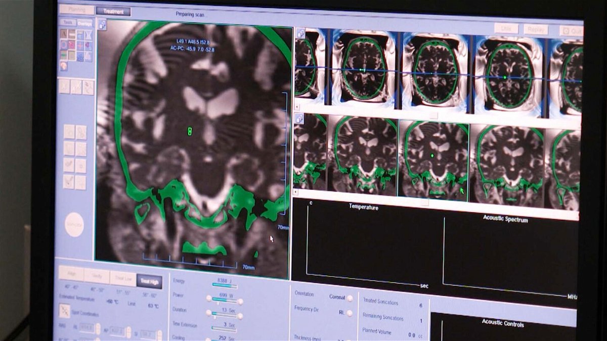 <i>CNN</i><br/>Pictured are scans of Hric's brain. Focused ultrasound signficantly improved the 80-year-old's tremors.