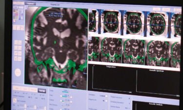 Pictured are scans of Hric's brain. Focused ultrasound signficantly improved the 80-year-old's tremors.