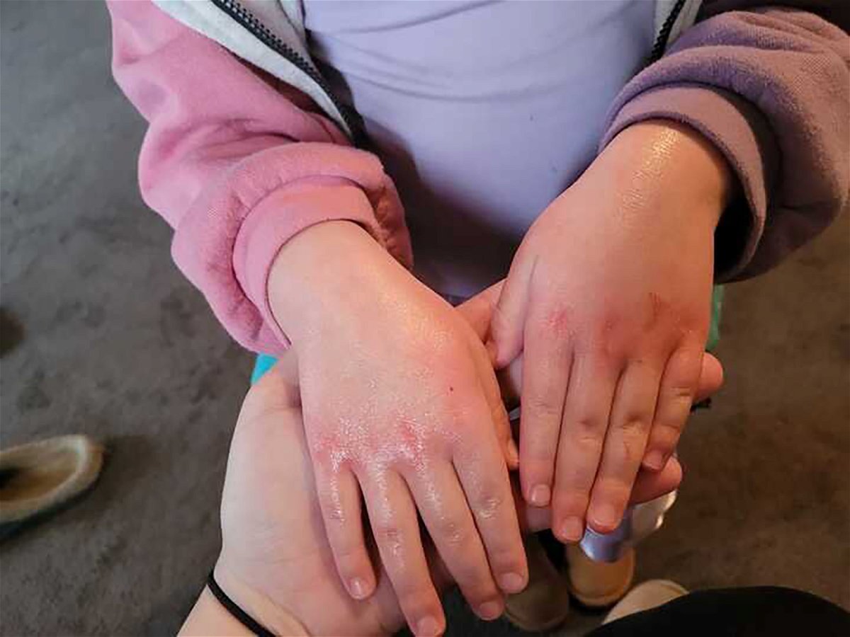 <i>Courtesy Ayla Sue Antoniazzi</i><br/>Ayla Antoniazzi's 4-year-old daughter developed a rash after going back to school in East Palestine.