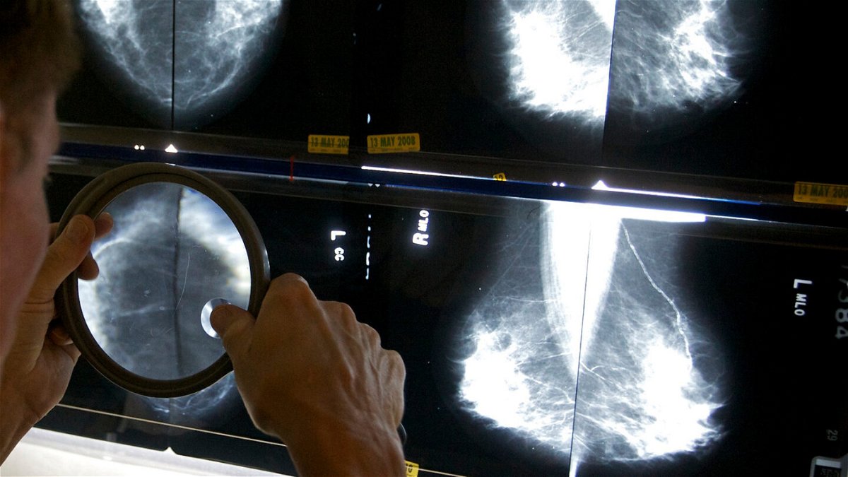 <i>Damian Dovarganes/AP</i><br/>New updates to US Food and Drug Administration mammography regulations require mammography facilities to notify patients about the density of their breasts.