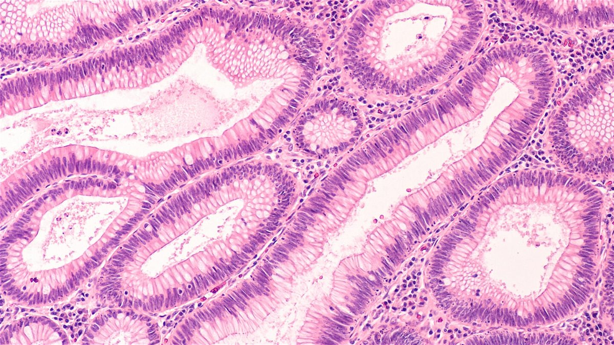 <i>shutterstock</i><br/>Microscopic image of a tubular adenoma. Adenomas are premalignant (precancerous) polyps of the colon and rectum. Colonoscopy can prevent cancer by removing adenomas before they transform to cancer.