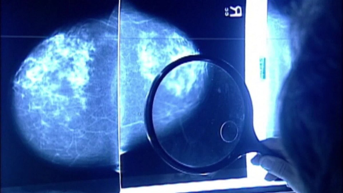 <i>CNN</i><br/>Breast cancer screenings are typically performed using a mammogram