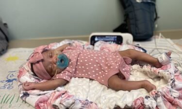 Doctors performed an in utero procedure on Denver Coleman to eliminate dangerous symptoms from a vascular malformation in her brain.