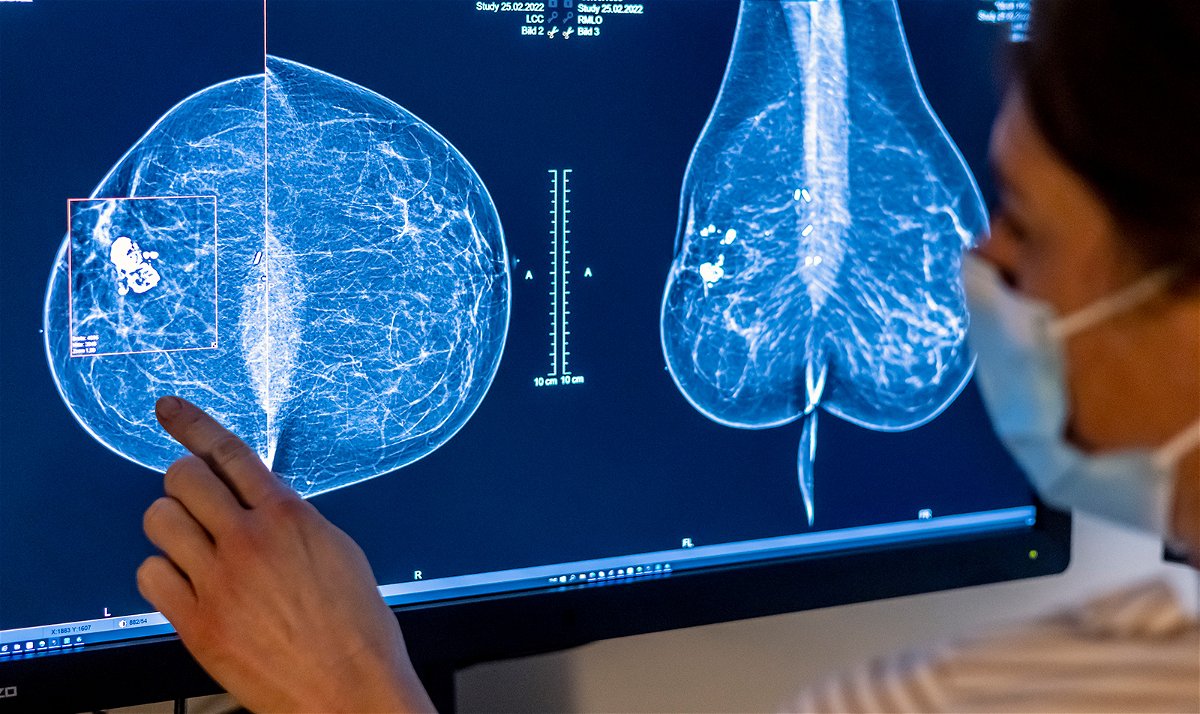 <i>Michael Hanschke/picture alliance/Getty Images</i><br/>Medical personnel use a mammogram to examine a woman's breast for breast cancer.