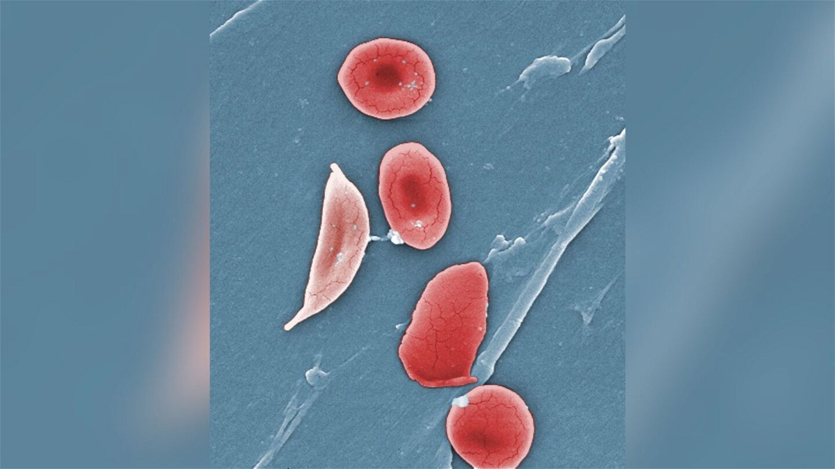 <i>Janice Haney Carr/AP</i><br/>This microscope image shows a sickle cell (left) and normal red blood cells of a patient with sickle cell anemia.