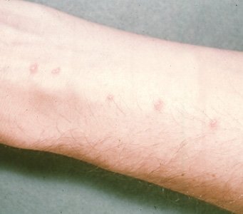 Reakcja alergiczna wywołana przez pasożyty ponownie zwraca uwagę na wysypkę zwaną „swędzeniem pływaka”