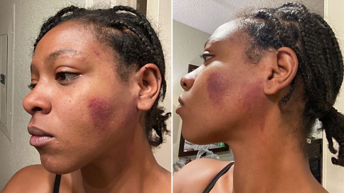 <i>Attorney Lauren Newton</i><br/>Photos of Christina Pierre taken one day after an encounter with police.