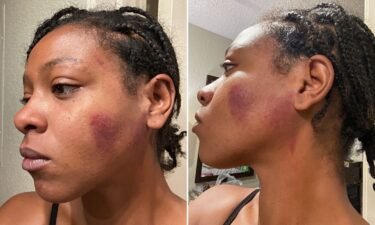 Photos of Christina Pierre taken one day after an encounter with police.