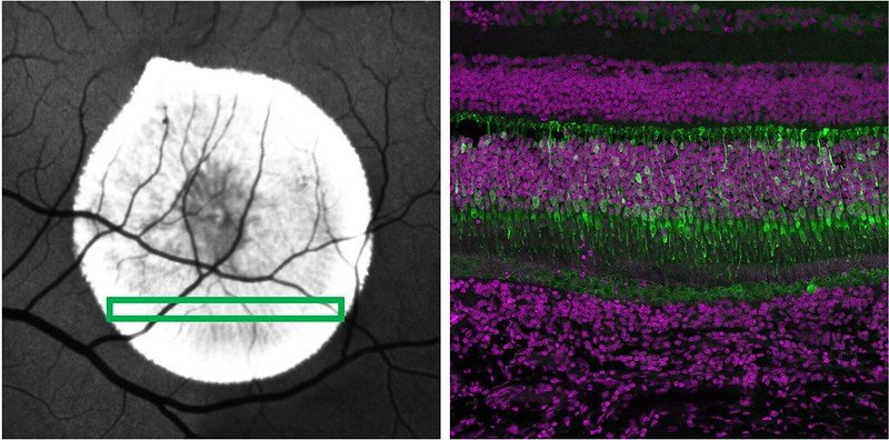 These images are the results of a subretinal injection. Left is the image of the injection site in the retina, the green box indicates the plane in which the right image was taken. Right is the immunofluorescence image of the retina section, with green indicating transfected cells and purple indicating all cell nuclei.