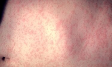 A red rash is one hallmark of a measles infection.