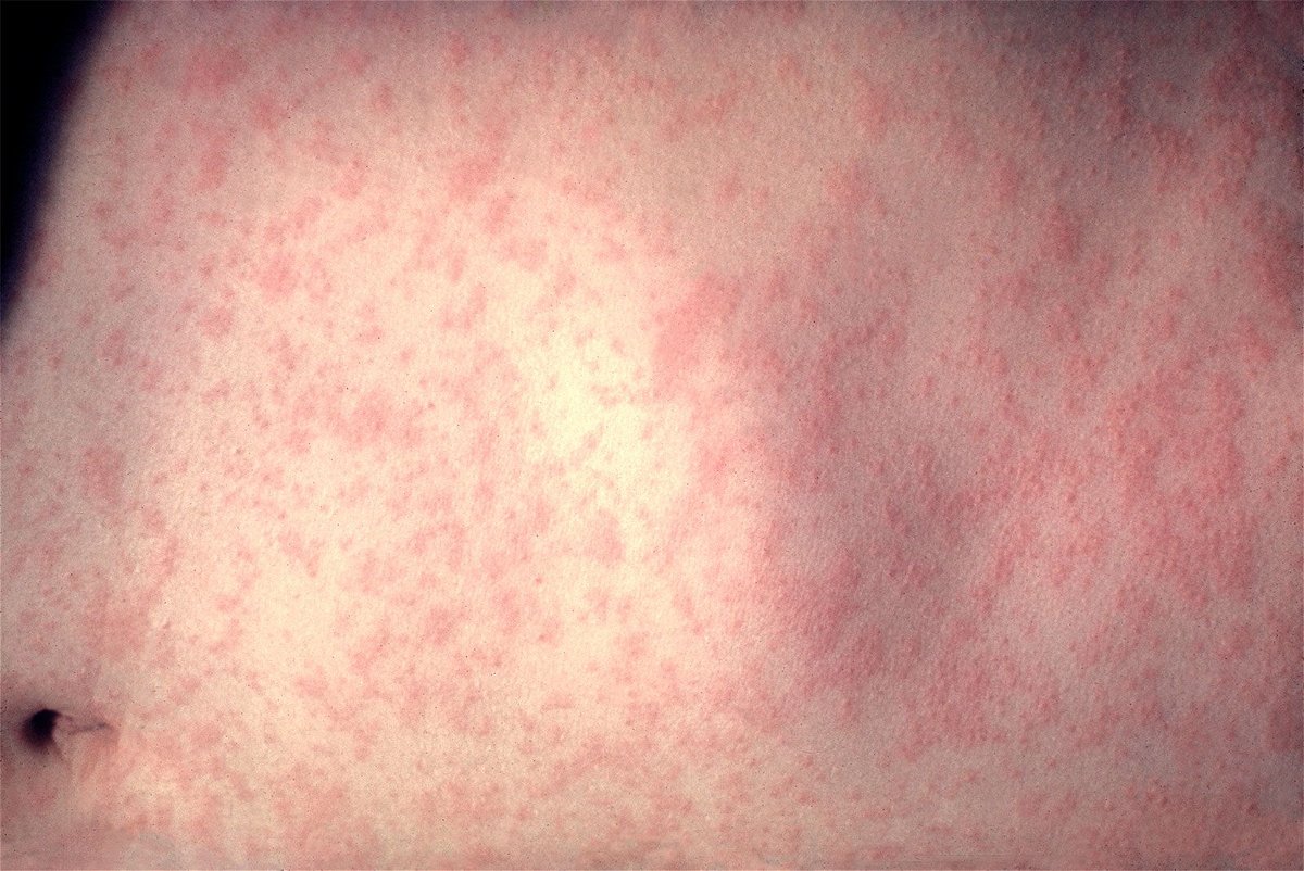 <i>CDC/FILE via CNN Newsource</i><br/>A red rash is one hallmark of a measles infection.