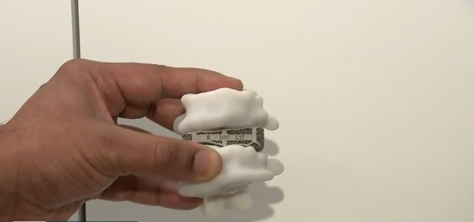 <i>KYW via CNN Newsource</i><br/>Jefferson Health is using new 3D technology for patients who need spinal fusion. This new high-tech back surgery is being used to create personalized spinal implants.