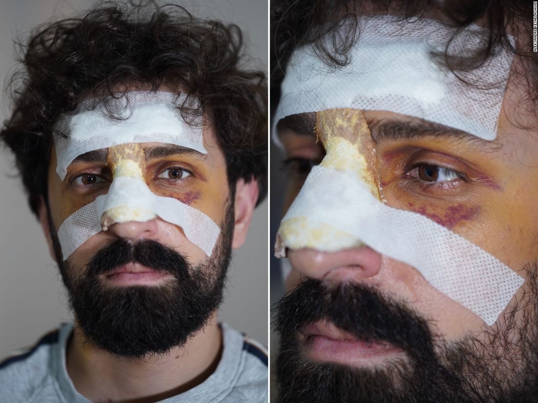 <i>Courtesy Aleksandre Keshelashvili via CNN Newsource</i><br/>Keshelashvili's bruises have deepened in the days after his assault.