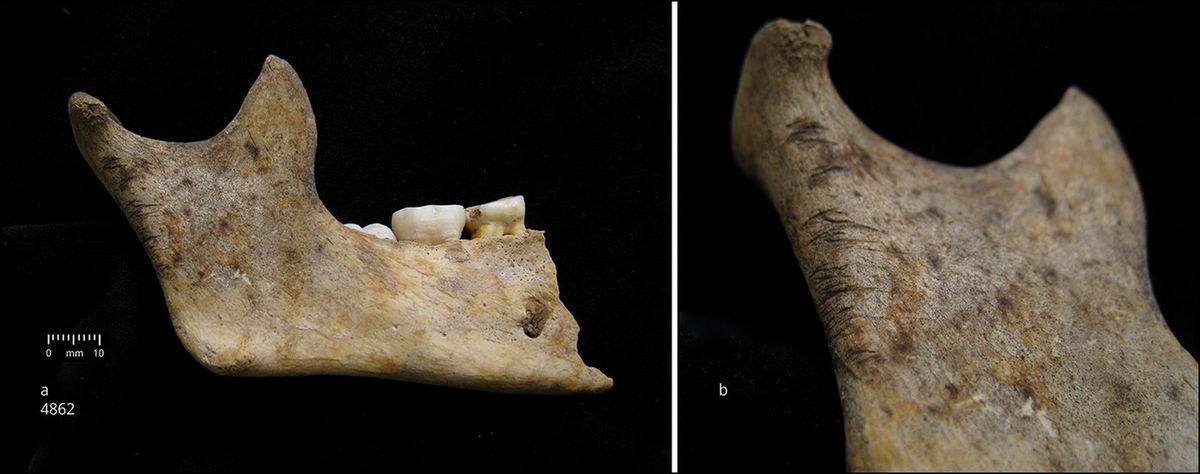 <i>Schulting et al. 2024 via CNN Newsource</i><br/>Cutmarks can be seen on the mandible of a 10-year-old child.