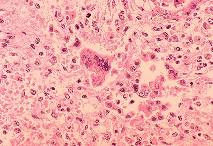<i>CDC/Getty Images via CNN Newsource</i><br/>Tissue with measles pneumonia is seen in a microscope image from 1972. Measles cases continue to accumulate in the United States.