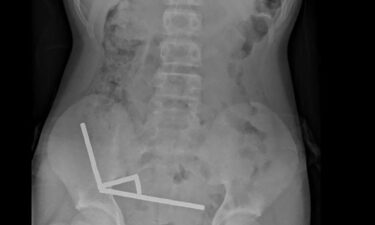 This undated handout released on Friday from the New Zealand Medical Journal (NZMJ) shows an x-ray image of pieces of high-power magnets clumped up in the intestines of a New Zealand teenager in Tauranga.